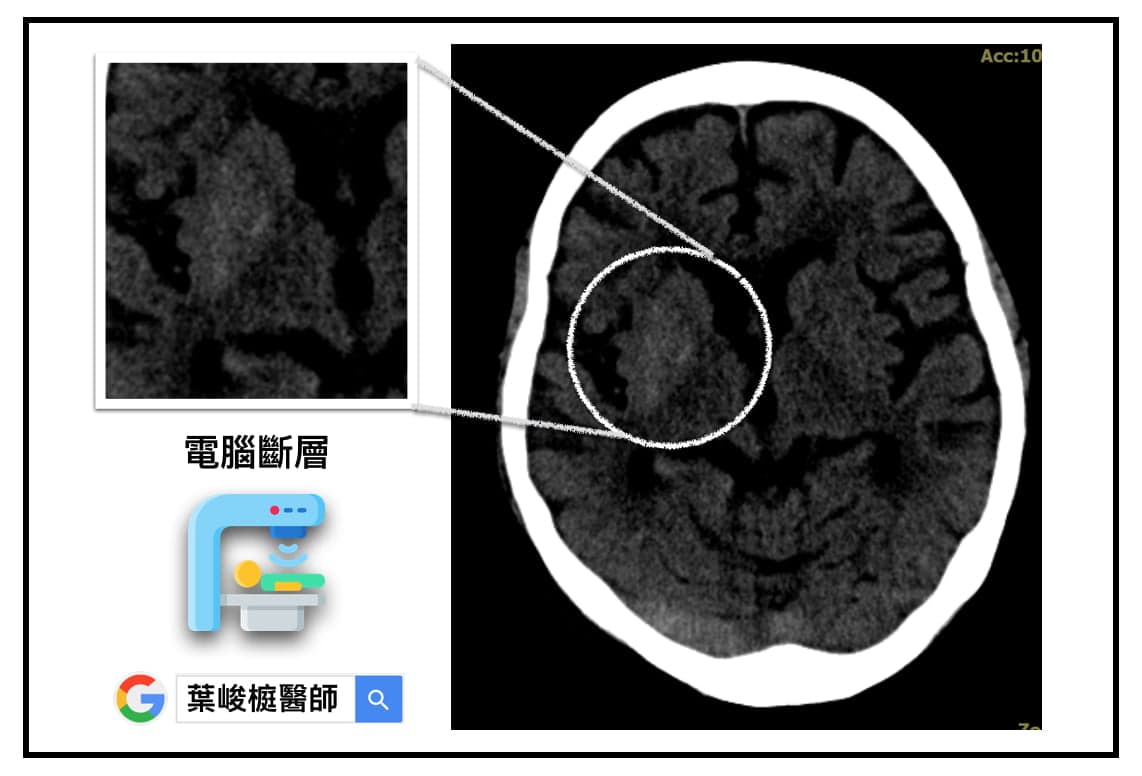 突發性單側舞蹈症 竟然是高血糖在作怪 新陳代謝 糖尿病 葉峻榳醫師